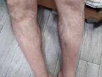 Тромбоз подколенного сустава. Почернение ноги фото 1