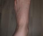 Боль в ногах и появление синяков фото 1