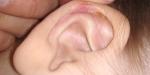 Аллергия за ушами фото 2