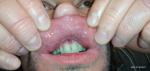 Уплотнения на губе и белые десна фото 4