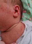 Сыпь у новорождённого фото 2