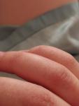 Трещины и покраснение на фалангах палец фото 3