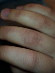 Трещины и покраснение на фалангах палец фото 2