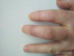 Посттравматический стойкий отёк 2, 3 пальцев левой кисти фото 3
