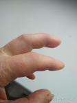 Посттравматический стойкий отёк 2, 3 пальцев левой кисти фото 5