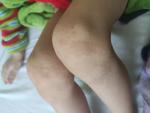 Подкожные высыпание на коленках у ребенка фото 1