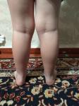 Сильный вальгус колен и стоп у ребёнка в 4 года фото 3