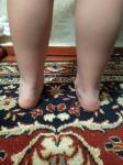 Сильный вальгус колен и стоп у ребёнка в 4 года фото 2