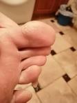Грибок пальцев ног фото 1