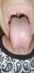 Прищі на язику у вигляді червоних бугорків фото 1