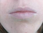 Шелушение губ и сухие пятна на коже фото 1