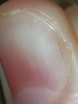 Черная продольная полоса на ногте фото 3