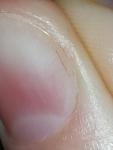 Черная продольная полоса на ногте фото 1