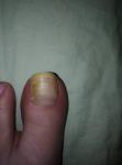 Проблемы с ногтями после тесной обуви фото 1