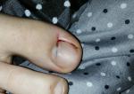 Порезала палец вместе с ногтем фото 1