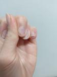 Меланома ногтя или грибок фото 2
