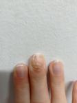 Меланома ногтя или грибок фото 1