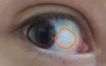 Что за точка на белке глаза? фото 1