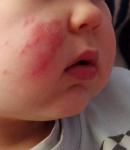 Аллергия на укус насекомого или стрептодермия фото 1
