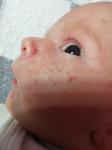 Сыпь на лице у младенца красного цвета с белой головкой фото 1