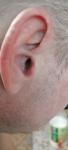 Грибок уха фото 1