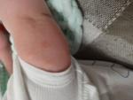 Красные шершавые пятна на руках у ребенка 6 месяцев фото 2