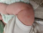 Красные шершавые пятна на руках у ребенка 6 месяцев фото 1