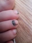 Гематома под ногтем у ребенка черного цвета фото 1