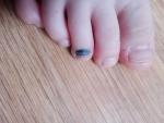 Гематома черного цвета под ногтем у ребенка фото 1