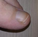 Пятно на ногтевой пластине ноги фото 2