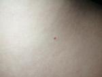 Красные пятна на теле и красные микро точки фото 5