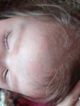 Пятна на лбу и волосах у ребенка фото 2