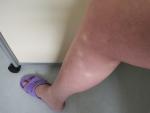 Багровые ноги при беременности фото 1