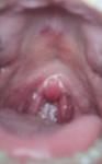 Красное горло, припухшие мидалины, припухший язычок, что это может быть? фото 1