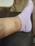 Болезненная шишка на ноге фото 1