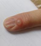 Новообразование на пальцах после травмы ногтевой пластины фото 2