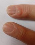 Новообразование на пальцах после травмы ногтевой пластины фото 1