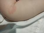 Красное пятно на изгибе руки у ребенка фото 2