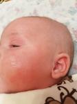 Высыпания у новорожденного по всему телу фото 3