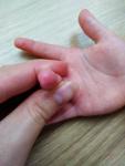 У ребенка сыпь на пальцах, дисгидротическая экзема? фото 4
