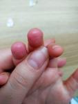 У ребенка сыпь на пальцах, дисгидротическая экзема? фото 1