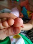 У ребенка сыпь на пальцах, дисгидротическая экзема? фото 5