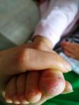 У ребенка сыпь на пальцах, дисгидротическая экзема? фото 3