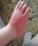 Ожог ног у ребенка фото 2