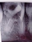 Воспаление корня зуба, перелечивание фото 1