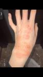 Потемнение кожи рук после аллергии фото 1