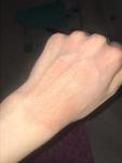 Потемнение кожи рук после аллергии фото 2
