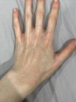 Потемнение кожи рук после аллергии фото 3