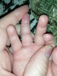 Корка на пальце у ребенка фото 1