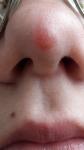 Красное пятно на носу у подростка фото 1